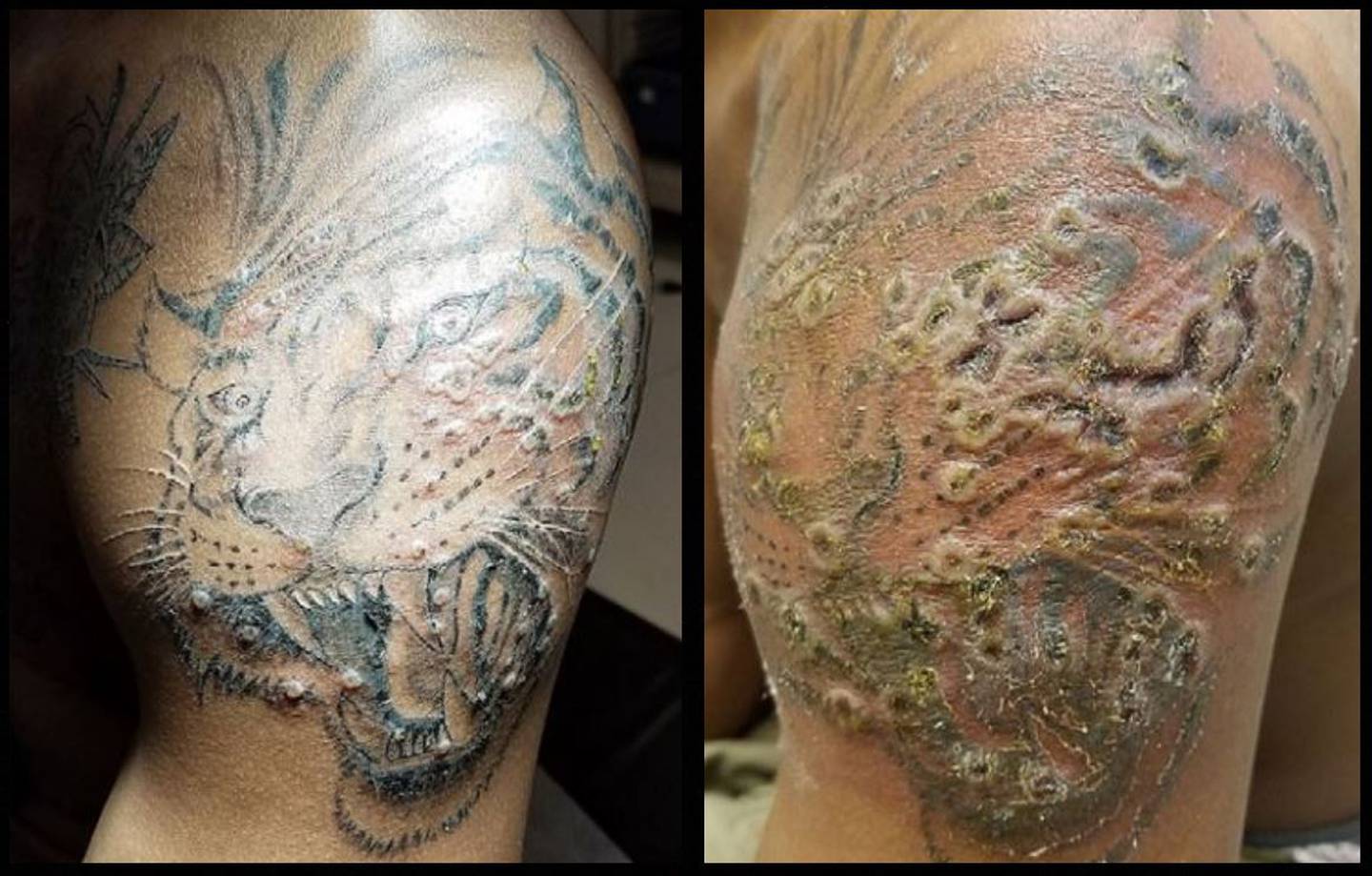 After tattoo. Аллергическая реакция на тату. Саркоидная реакция на тату. Тату ноябрь 1984. Лихеноидная реакция на тату фото.